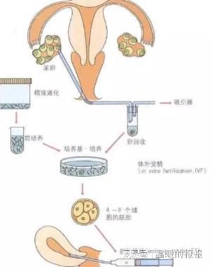 关于取卵移植费用的全面解析
