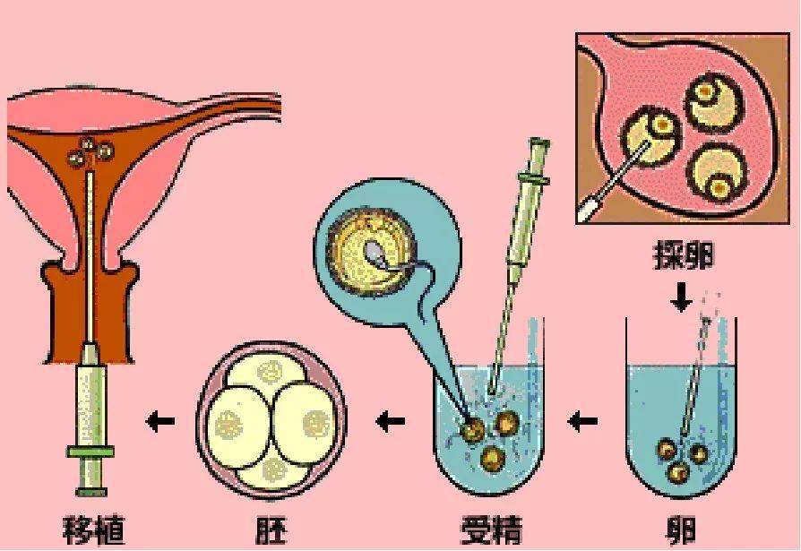 试管自然周期取卵，一种更自然的生育选择